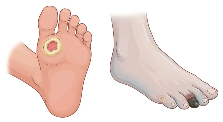 Plante du pied avec un ulcère arrondi sous la première tête métatarsienne entouré d'une callosité, à côté d'un pied ischémique pâle présentant une gangrène sèche noire du deuxième orteil et une petite ulcération du cinquième orteil.