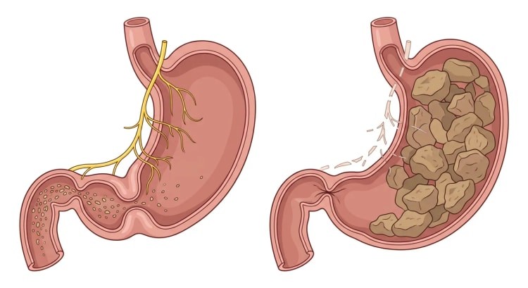 Deux estomacs côte à côte : l'un normal avec un nerf vague intact, une contraction antrale et un pylore ouvert, l'autre atteint de gastroparésie avec des branches nerveuses lésées, des aliments solides résiduels et un pylore fermé.