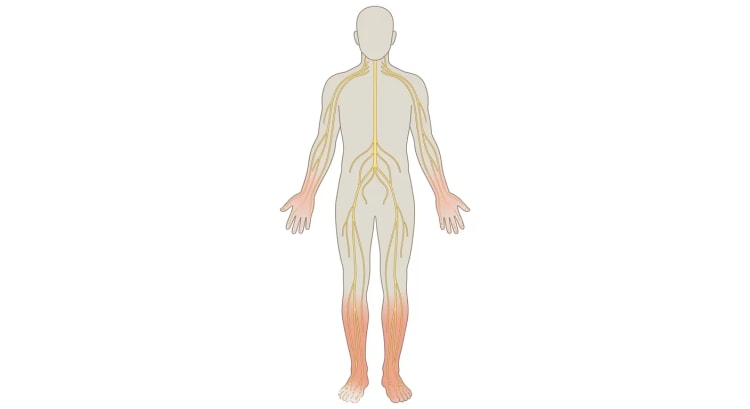 Vue de face du corps entier avec les nerfs périphériques en jaune. Les pieds, les jambes et les mains sont teintés de rouge, et les terminaisons nerveuses des orteils et des doigts sont fragmentées.