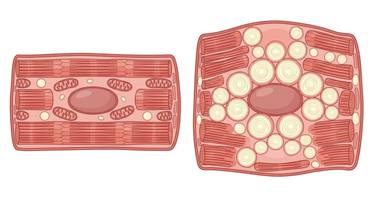 Cardiomyocyte normal à côté d'un cardiomyocyte hypertrophié dans la maladie de Fabry, avec de nombreux lysosomes gonflés autour du noyau cellulaire