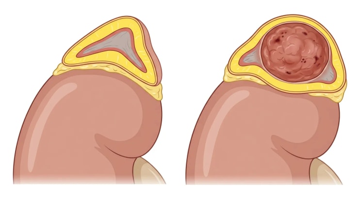Coupe transversale d'une surrénale au-dessus du pôle supérieur du rein : à gauche une surrénale normale avec un cortex jaune et une médullaire grise, à droite une tumeur ronde brun-rouge dans la médullaire entourée d'un cortex distendu.