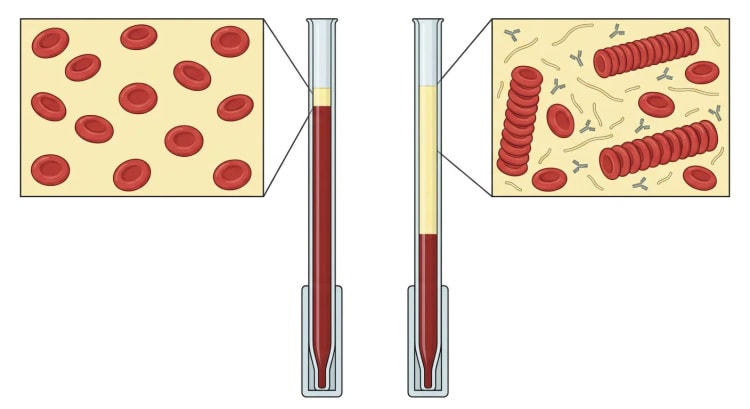 Deux tubes de Westergren avec des agrandissements du sang : à gauche, des érythrocytes flottant librement et une fine couche de plasma ; à droite, des agrégats en rouleaux parmi le fibrinogène et les anticorps et une couche de plasma nettement plus haute.