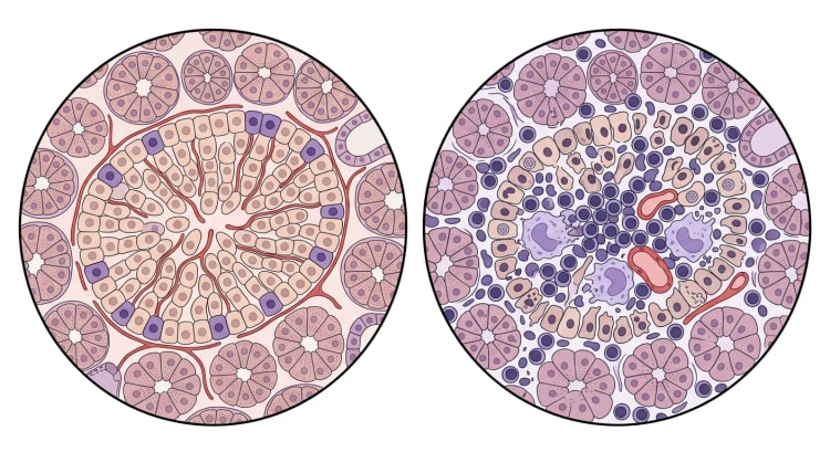 Deux coupes agrandies de tissu pancréatique : à gauche, un îlot de Langerhans normal entouré d'acini ; à droite, le même îlot infiltré de lymphocytes et de macrophages avec des cellules bêta en cours de destruction.