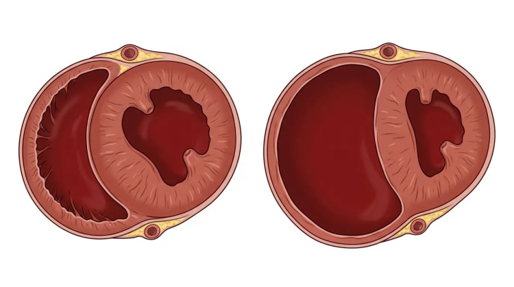 Deux coupes transversales des ventricules en petit axe. À gauche un cœur normal avec un ventricule droit à paroi fine en forme de croissant. À droite un ventricule droit fortement dilaté avec un septum aplati et un ventricule gauche en forme de D.