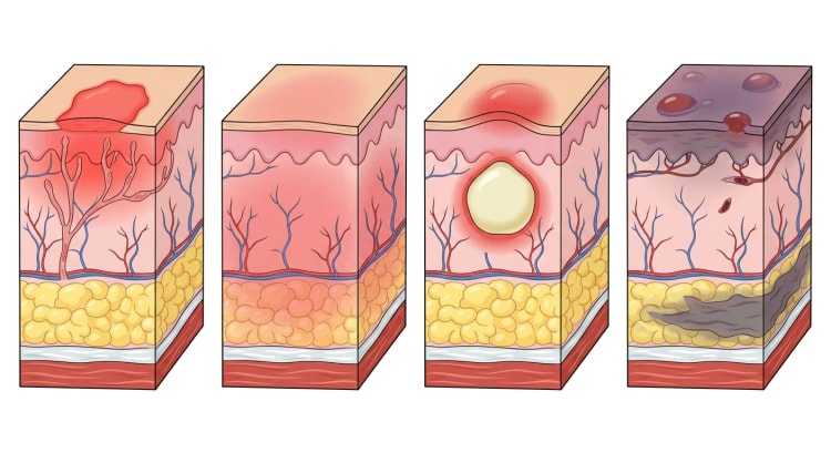 Quatre coupes transversales de la peau et des parties molles côte à côte montrant un érysipèle, une cellulite, un abcès et une fasciite nécrosante.