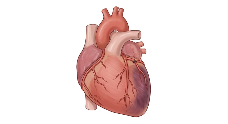 Cœur vu de face avec un thrombus dans l'artère circonflexe gauche et une zone d'infarctus sombre dans la paroi latérale du ventricule gauche.