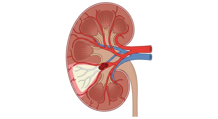 Coupe frontale d'un rein dans lequel un embole occlut une artère segmentaire. En aval de l'embole, on observe un infarctus pâle cunéiforme avec une fine bande préservée de cortex perfusé sous la capsule.