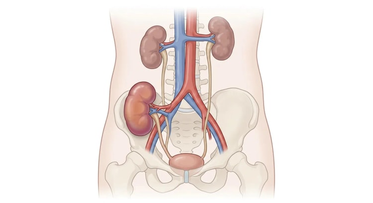 Abdomen et pelvis vus de face avec les deux reins natifs en position normale et un rein transplanté dans la fosse iliaque droite, raccordé aux vaisseaux pelviens et à la vessie.