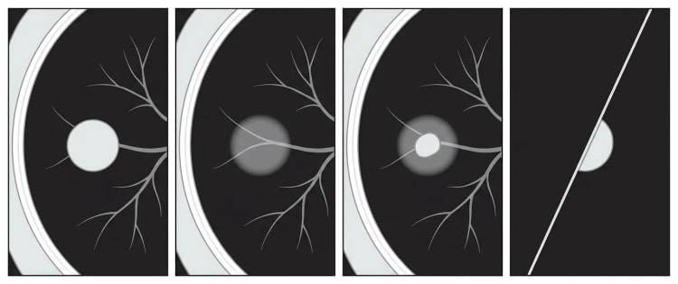 Quatre extraits schématiques de tomodensitométrie pulmonaire en fenêtre parenchymateuse : nodule solide, nodule en verre dépoli pur, nodule partiellement solide et nodule périscissural.