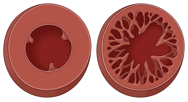 Deux coupes petit axe du ventricule gauche : à gauche une paroi normale, uniformément compacte, à droite une paroi à deux couches avec une fine couche externe compacte et une épaisse couche interne trabéculée.