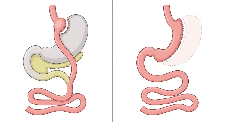Deux panneaux représentant le tube digestif : à gauche l'anatomie après bypass gastrique Roux-en-Y, à droite après gastrectomie longitudinale (sleeve).