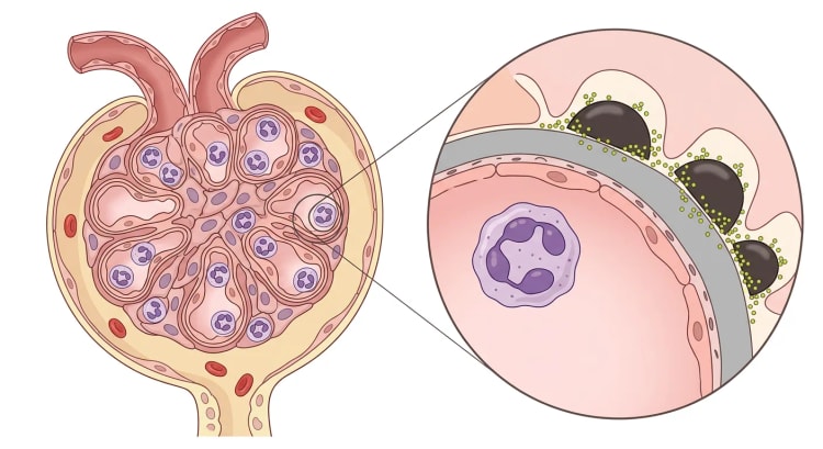 Glomérule au cours d'une glomérulonéphrite post-streptococcique avec un peloton capillaire hypercellulaire et des polynucléaires neutrophiles, ainsi qu'une paroi capillaire agrandie avec des dépôts sous-épithéliaux de complexes immuns.