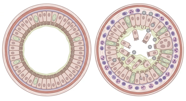Coupe transversale d'une bronchiole saine à côté d'une bronchiole infectée par le VRS avec perte des cils, cellules épithéliales desquamées, mucus, cellules inflammatoires et lumière rétrécie.