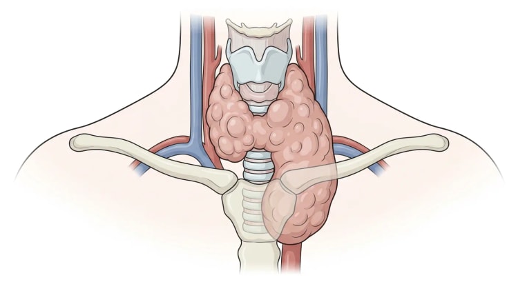 Cou vu de face avec une thyroïde bosselée fortement et asymétriquement hypertrophiée, dont un lobe descend derrière le manubrium et comprime la trachée.