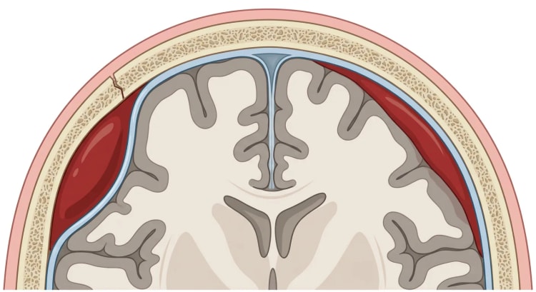 Coupe coronale du crâne et du cerveau. À gauche, un hématome extradural lenticulaire sous une fracture du crâne et, à droite, un hématome sous-dural en croissant.