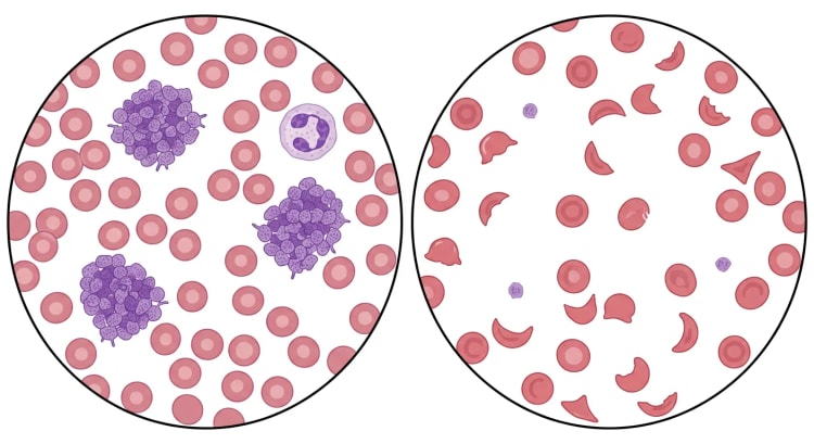 Deux champs microscopiques de frottis sanguin. À gauche, des érythrocytes normaux, un polynucléaire neutrophile et trois grands amas de plaquettes. À droite, des érythrocytes fragmentés et quelques plaquettes libres isolées.