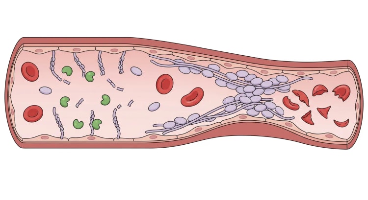 Coupe longitudinale d'une artériole. À gauche, de courts filaments de facteur von Willebrand sont clivés par ADAMTS13 ; à droite, de longs filaments non clivés auxquels sont liées des plaquettes forment un microthrombus, et en aval on observe des érythrocytes fragmentés.