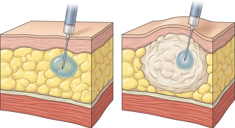 Deux coupes transversales de la paroi abdominale avec la peau, la graisse sous-cutanée et le muscle. À gauche, le dépôt d'insuline se situe dans une graisse sous-cutanée normale et à droite dans un nodule de lipohypertrophie.