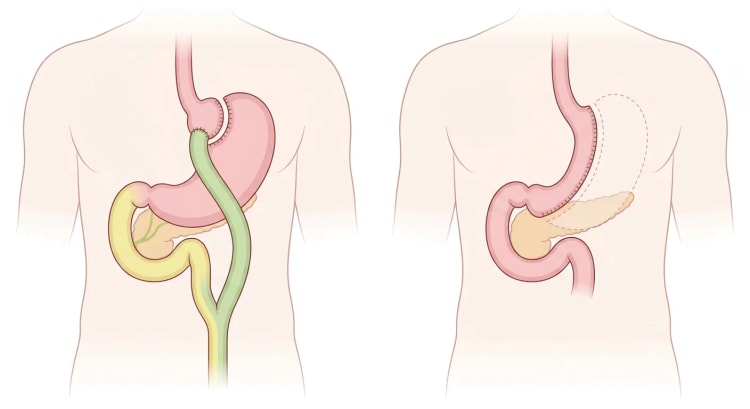 Anatomie schématique après bypass gastrique Roux-en-Y à gauche et gastrectomie longitudinale (sleeve) à droite, vue de face.
