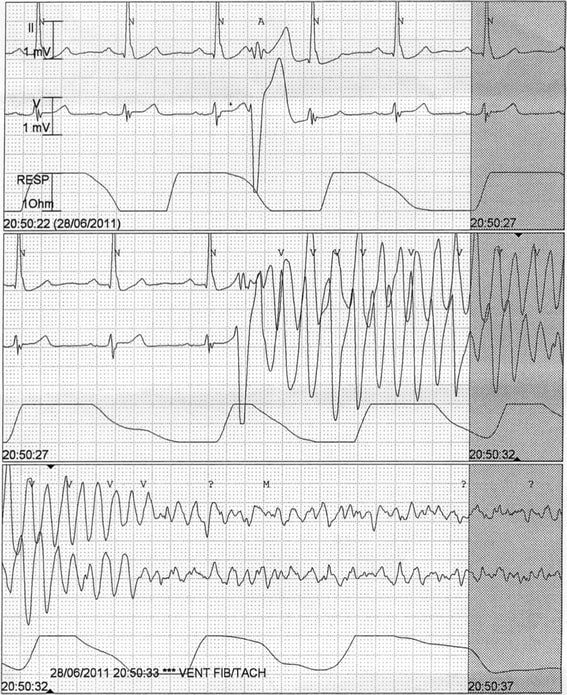 ECG montrant une tachycardie ventriculaire polymorphe dégénérant en fibrillation ventriculaire.