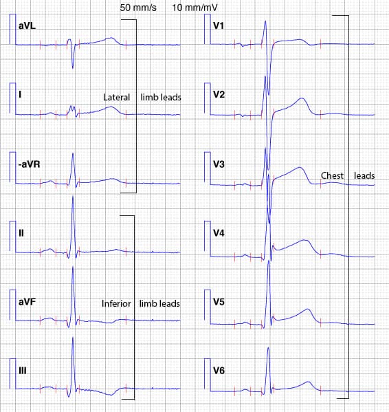 Illustration ur kursen Tests ECG (Quiz)