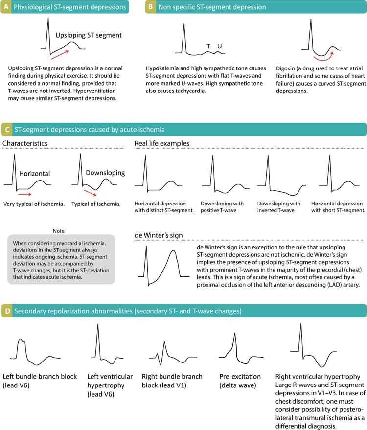 Figure 15. Différentes causes de dépressions du segment ST et leur apparence