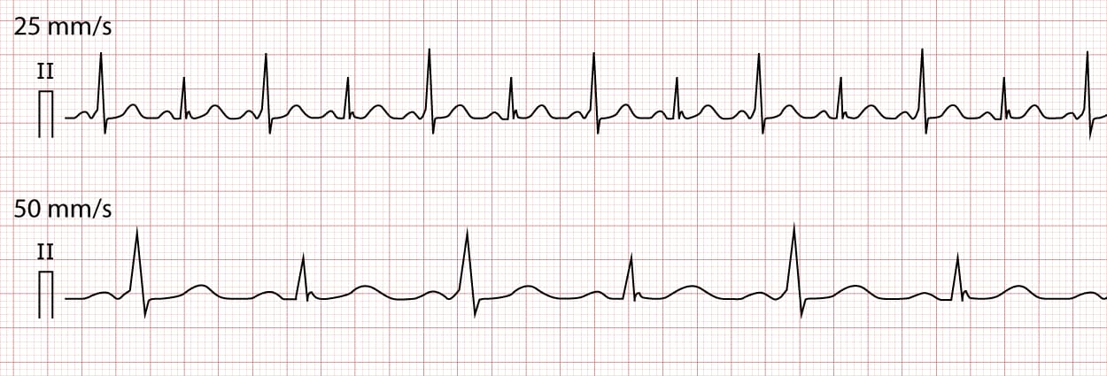 Illustration ur kursen Interprétation de l'ECG pédiatrique et néonatal