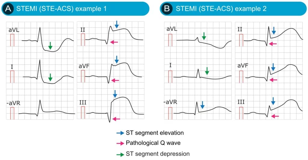 Illustration ur kursen Interprétation de l'ECG clinique