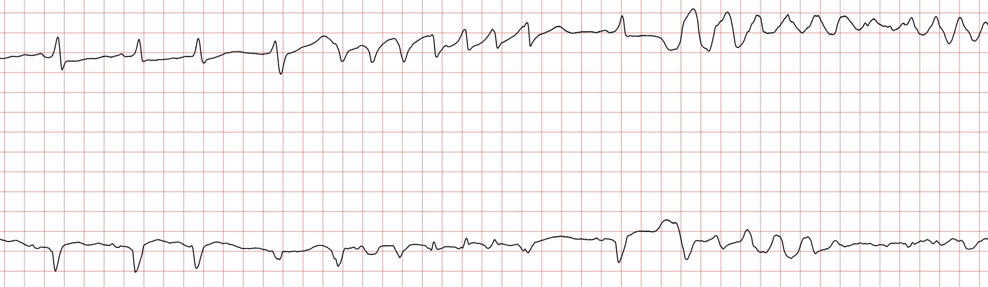 Illustration ur kursen Arrêt cardiaque soudain et réanimation cardio-pulmonaire (RCP)