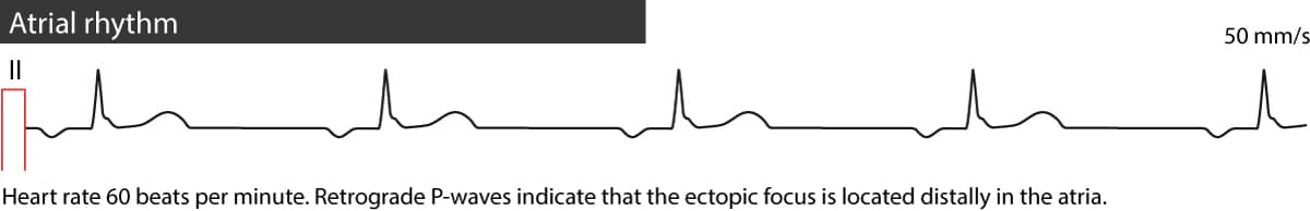 Figure 1. Rythme auriculaire ectopique. Notez la morphologie de l'onde P différente du rythme sinusal habituel et une cadence régulière.