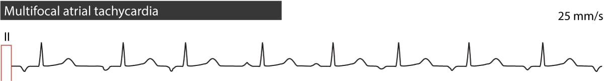 Figure 4. Tachycardie auriculaire multifocale. Notez l'irrégularité du rythme et la variation morphologique des ondes P.