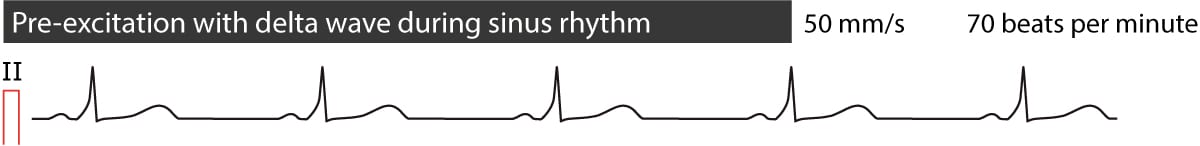 Figure 5. Préexcitation en rythme sinusal.