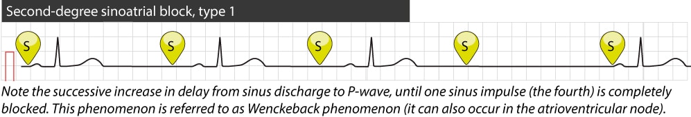 Figure 2. Bloc sino-auriculaire du second degré de type 1.