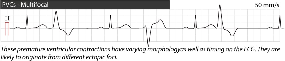 Figure 5. Contractions ventriculaires prématurées multifocales.