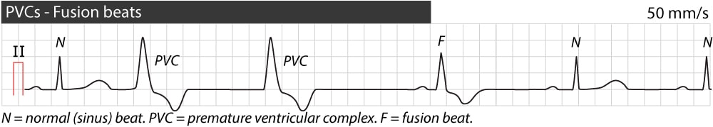 Figure 6. Battement de fusion.