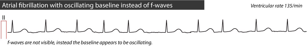 Figure 2. Fibrillation auriculaire sans ondes f visibles. Au lieu de cela, on observe de minuscules oscillations de la ligne de base.