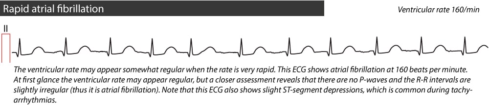 Figure 3. Fibrillation auriculaire rapide.