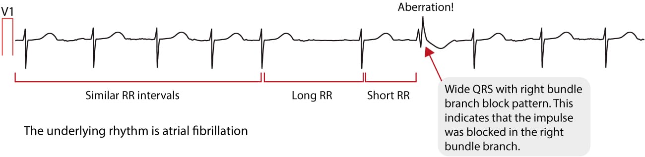 Figure 4. ECG montrant le phénomène d’Ashman