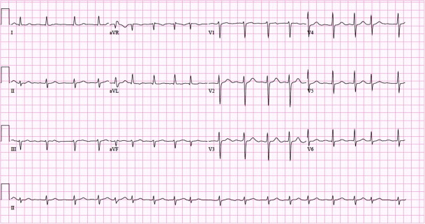 Figure 5. Exemple d’ECG à 12 dérivations avec fibrillation auriculaire. Vitesse du papier : 25 mm/s.