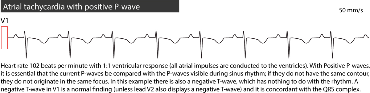 Figure 3. Tachycardie auriculaire. Notez l'intervalle RP long.