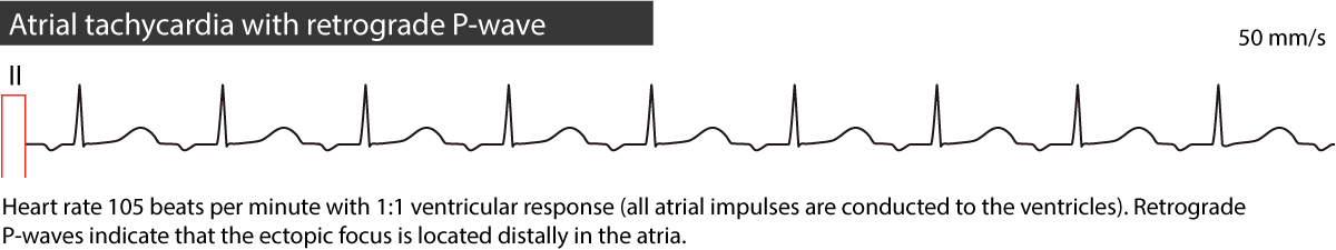 Tachycardie atriale ectopique avec ondes P rétrogrades, négatives en II