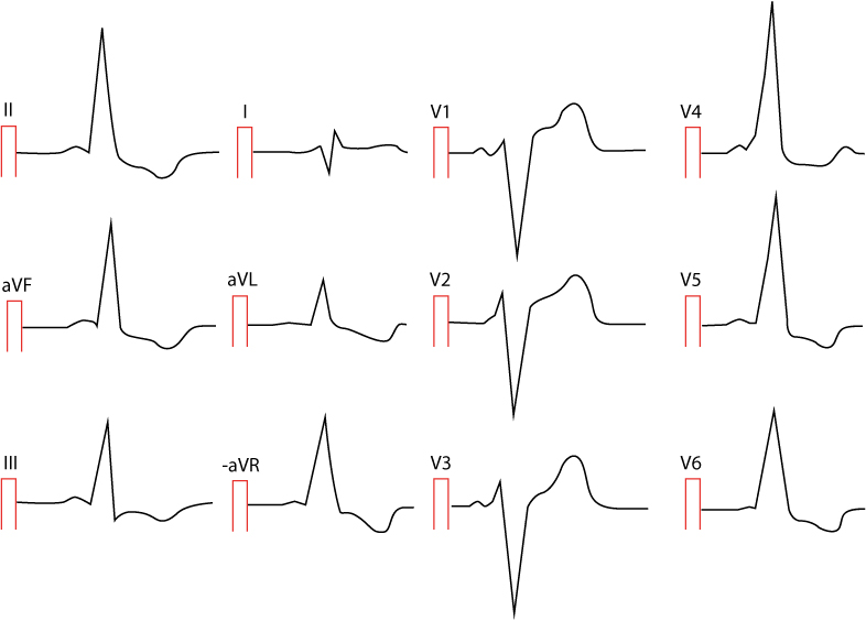 Figure 2. Pré-excitation chez une femme de 25 ans. De nombreuses dérivations présentent une dépression du segment ST et une inversion de l’onde T. L’intervalle PR est très court, les complexes QRS sont larges et les ondes delta sont présentes dans de nombreuses dérivations. Pouvez-vous les repérer ?