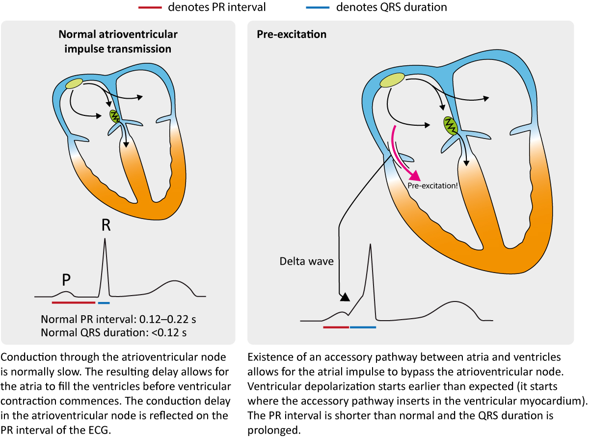 Figure 1. Caractéristiques de la préexcitation sur l’ECG.