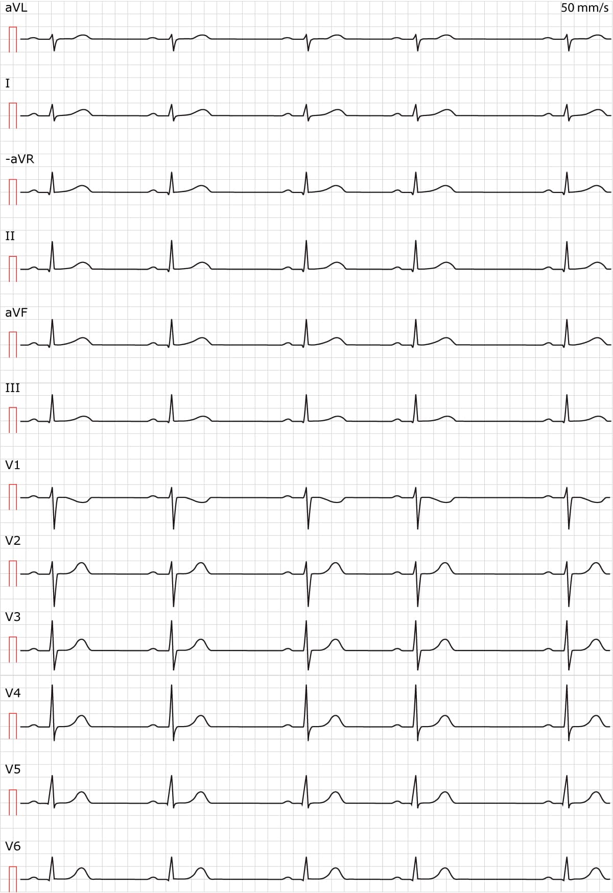 Figure 1. Arythmie sinusale (arythmie sinusale respiratoire).
