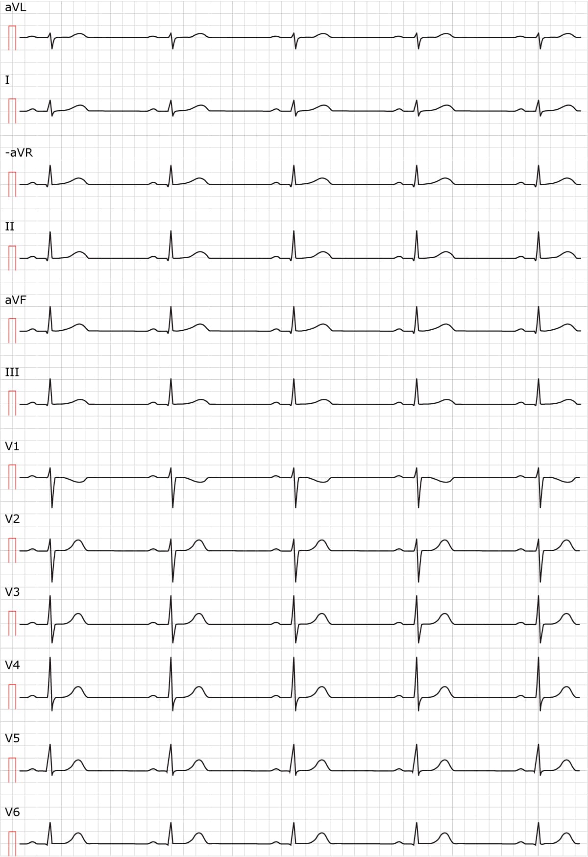 Figure 2. Rythme sinusal. Vitesse du papier 50 mm/s.