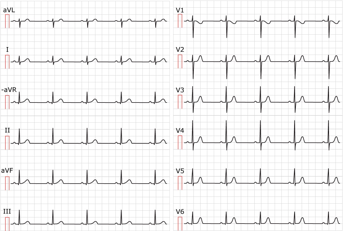 Figure 1. Rythme sinusal. Vitesse du papier 25 mm/s. Noter l'axe normal de l'onde P.