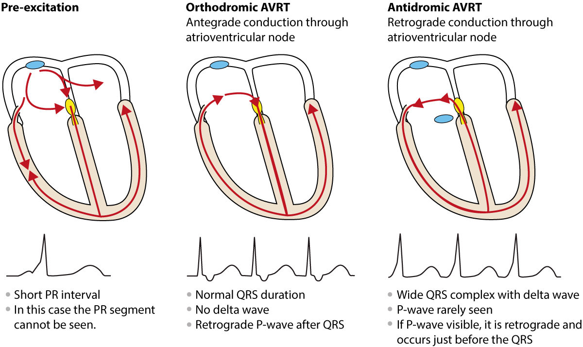 Figure 3. TAVR antidromique et orthodromique.