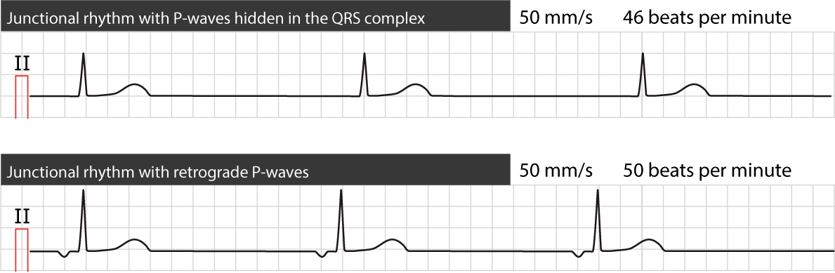 Figure 1. Deux types de rythme jonctionnel (d’échappement).