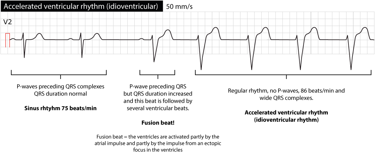 Figure 2. Rythme idioventriculaire accéléré (RIVA) avec compétition. Notez le complexe de fusion (intermédiaire entre le QRS sinusal et le QRS ventriculaire) qui précède l'installation du rythme ventriculaire.