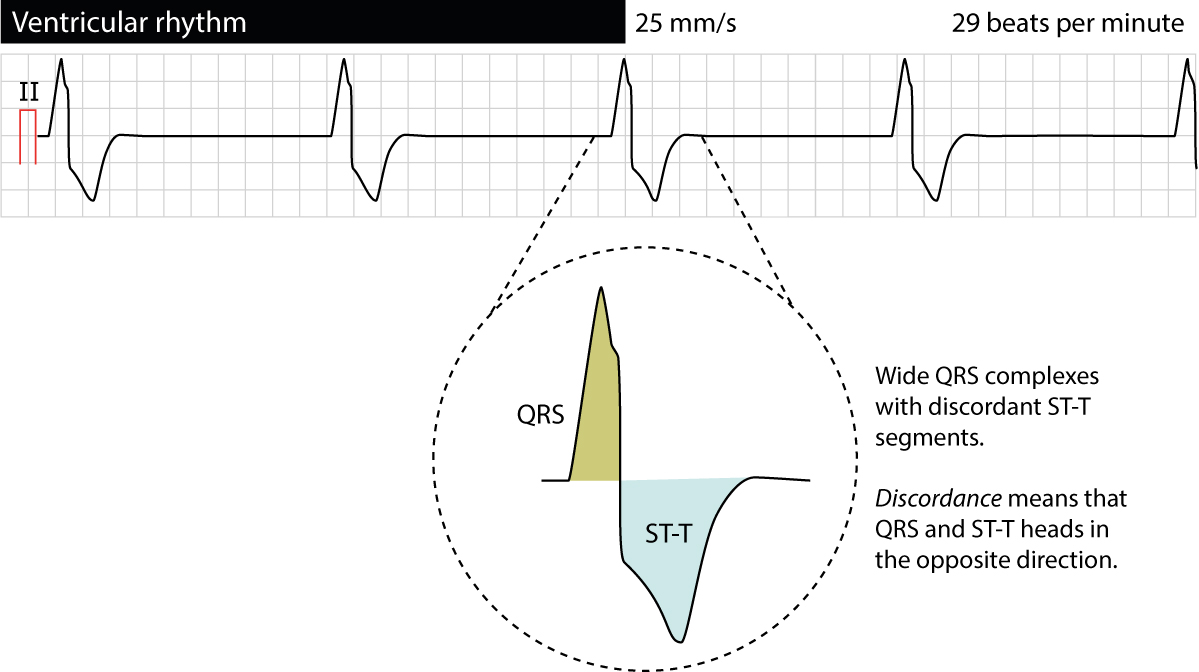 Figure 1. Rythme ventriculaire d'échappement. Notez la bradycardie, les QRS larges et la discordance appropriée de la repolarisation.